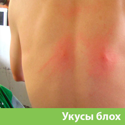 Укусы блох в Михайловке